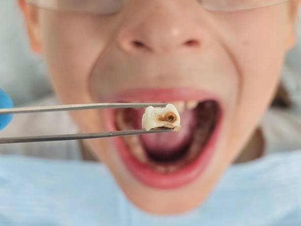Best Emergency Treatment for Dental Infections or Abscesses in Mooreville, MS